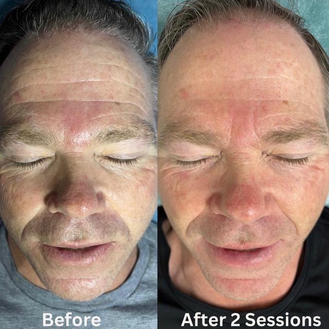 (3) Microchanneling Treatments