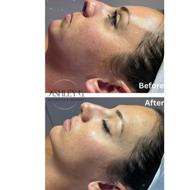 (3) Fauxtox Facials